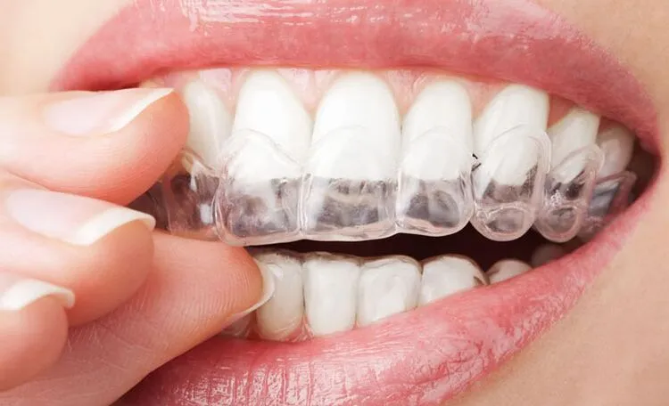 Ortodoncia Invisible